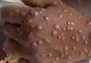 Guinée : 7 cas de Mpox confirmés et quatre maladies sous surveillance, selon l’Agence Nationale de Sécurité Sanitaire