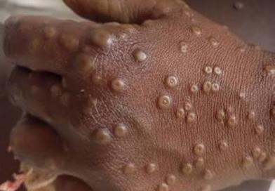 Guinée : 7 cas de Mpox confirmés et quatre maladies sous surveillance, selon l’Agence Nationale de Sécurité Sanitaire...