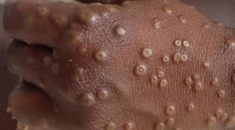 Guinée : 7 cas de Mpox confirmés et quatre maladies sous surveillance, selon l’Agence Nationale de Sécurité Sanitaire